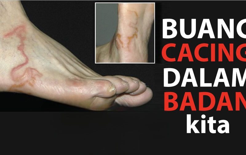 Detox Parasit: Cara Efektif Membuang Cacing Dalam Badanft